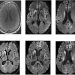 Creutzfeldt-Jakob Disease