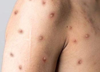 Monkeypox
