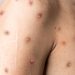 Monkeypox