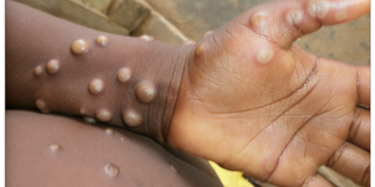 United States Confirms 2 Cases Of Monkeypox In Children