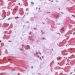 Myocarditis (2)