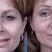Bell's Palsy