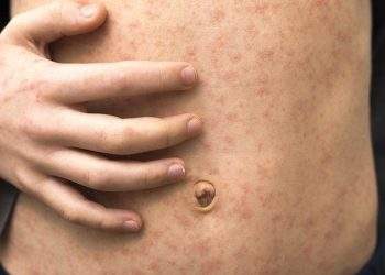 Measles