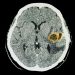 Brain Parasites