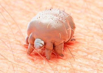 Scabies