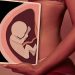 Abortion