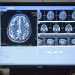 Are Conservative and Liberal Brains Different? Maybe Just a Little