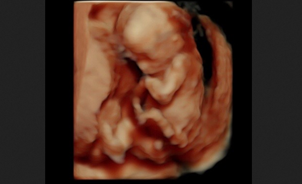62,000 Babies Older Than 15 Weeks are Killed in Abortions Every Year