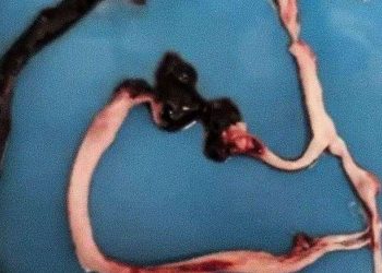 Clots