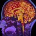 Brain Inflammation